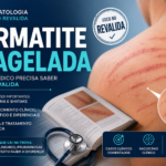 Dermatite flagelada: o que o médico precisa saber para o Revalida